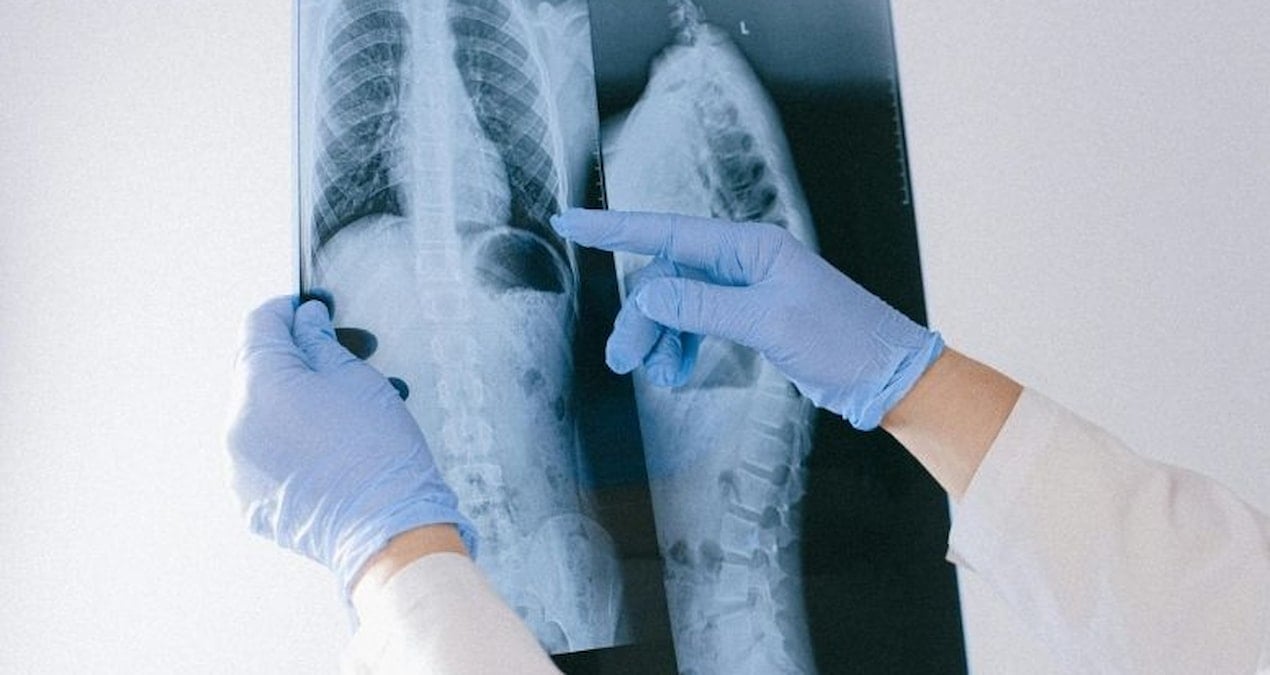 Nefes darlığı şikayetiyle hastaneye gitti! Tümörün büyüklüğü doktorları dahi şaşırttı